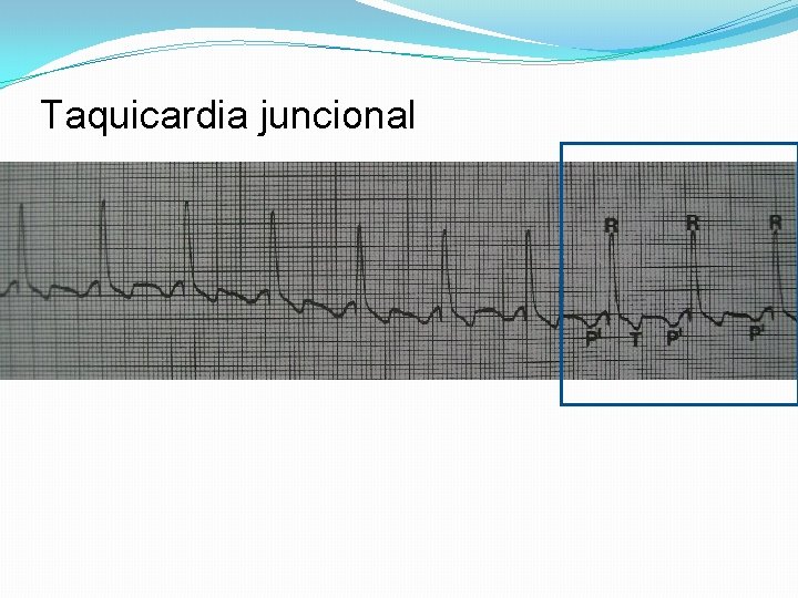 Taquicardia juncional 