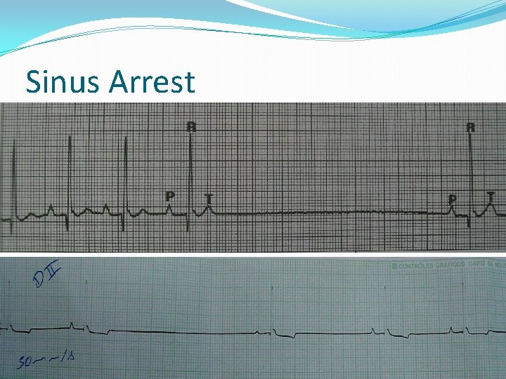 Sinus Arrest 