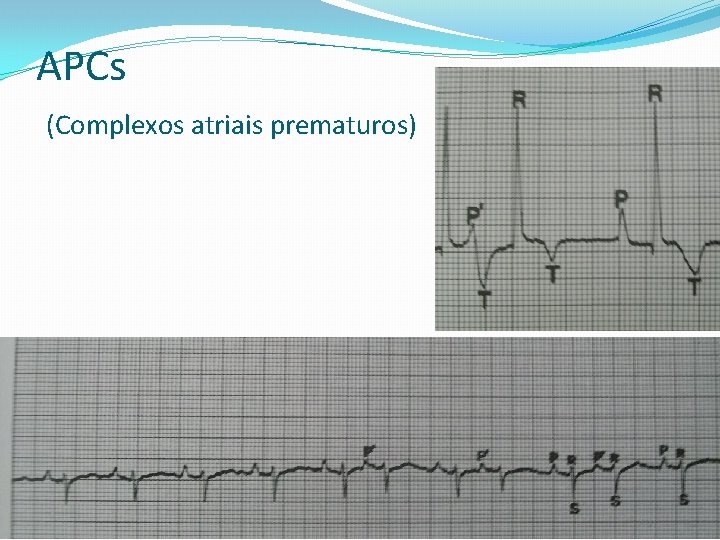 APCs (Complexos atriais prematuros) 