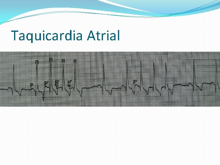 Taquicardia Atrial 