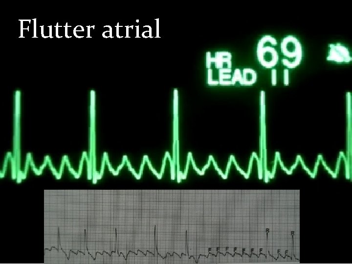 Flutter atrial 