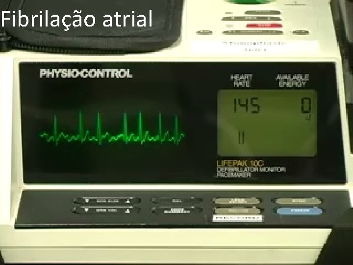 Fibrilação atrial 