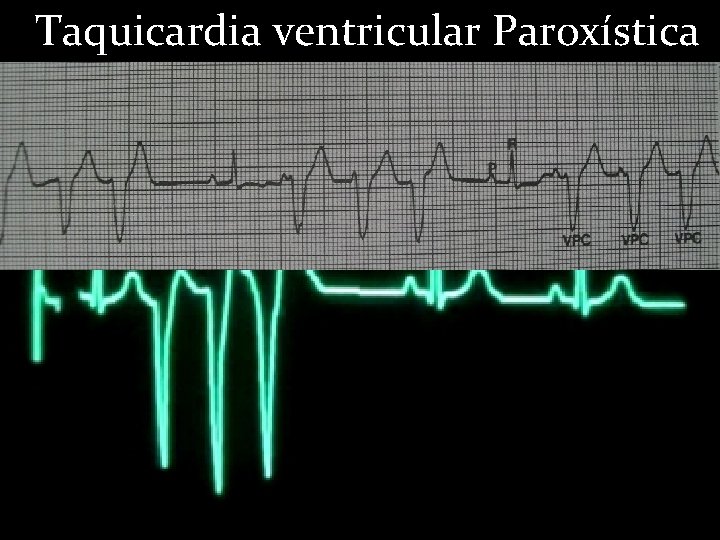 Taquicardia ventricular Paroxística 