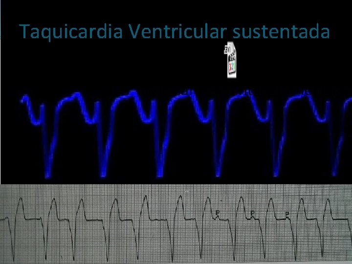 Taquicardia Ventricular sustentada 