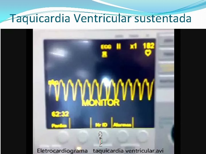 Taquicardia Ventricular sustentada 