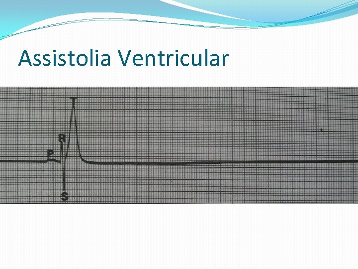 Assistolia Ventricular 