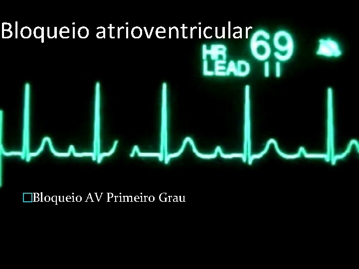 Bloqueio atrioventricular �Bloqueio AV Primeiro Grau 