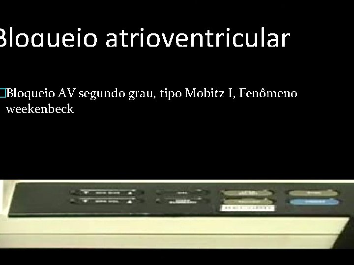 Bloqueio atrioventricular �Bloqueio AV segundo grau, tipo Mobitz I, Fenômeno weekenbeck 