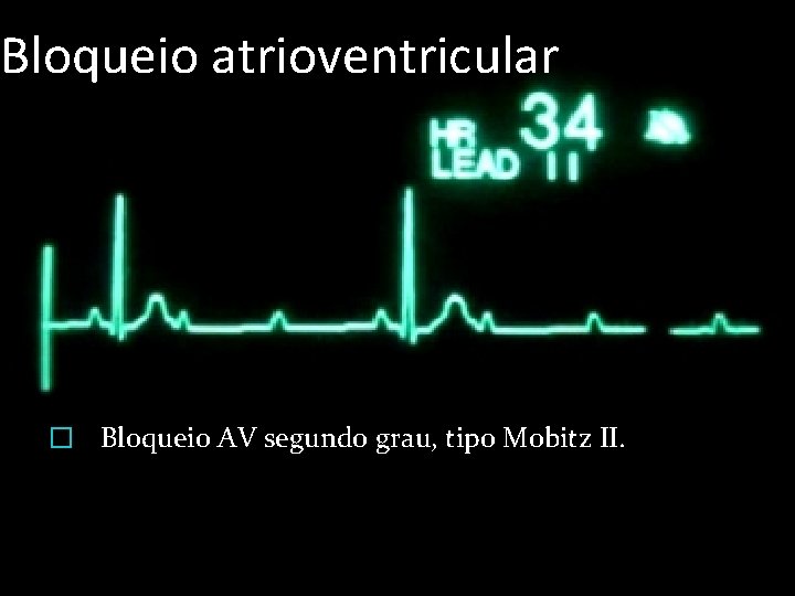 Bloqueio atrioventricular � Bloqueio AV segundo grau, tipo Mobitz II. 