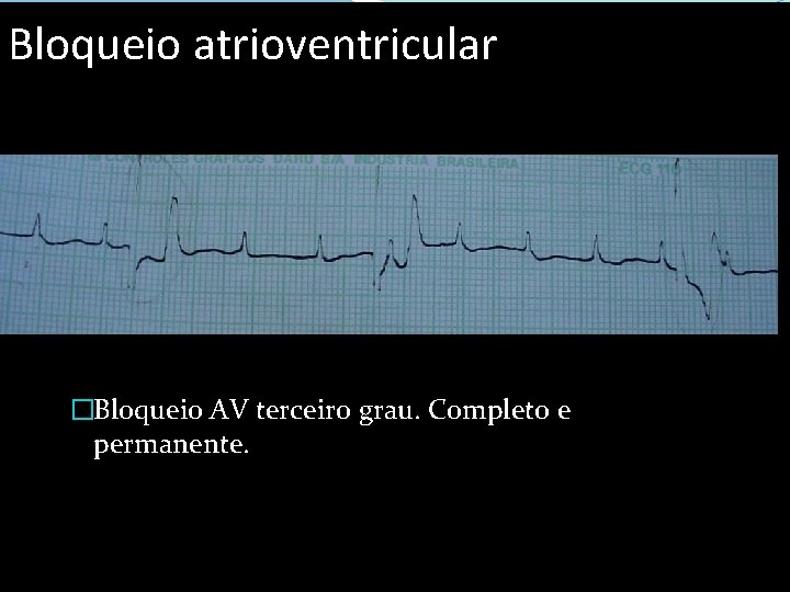 Bloqueio atrioventricular �Bloqueio AV terceiro grau. Completo e permanente. 