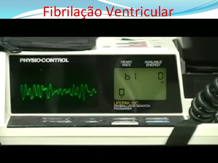 Fibrilação Ventricular 