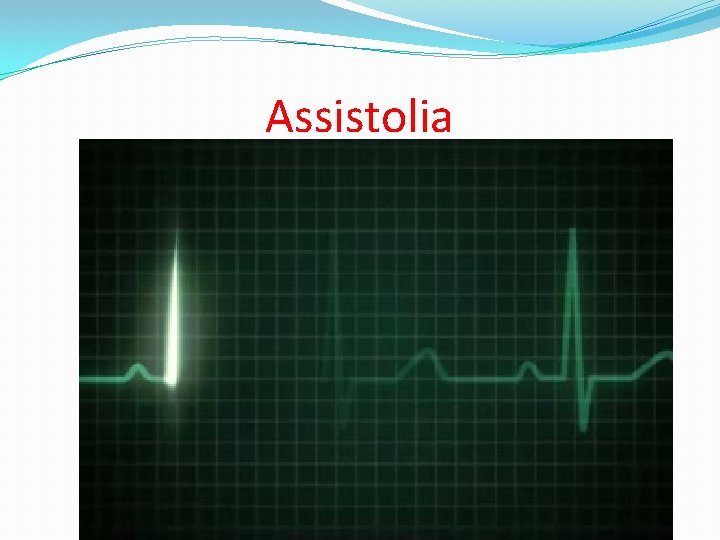 Assistolia 