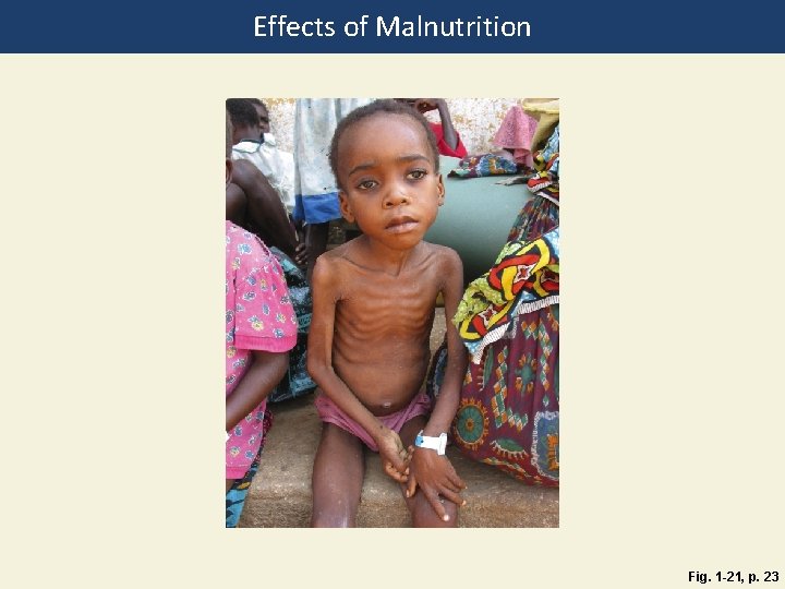 Effects of Malnutrition Fig. 1 -21, p. 23 