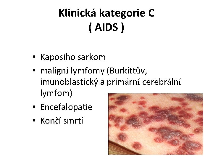 Klinická kategorie C ( AIDS ) • Kaposiho sarkom • maligní lymfomy (Burkittův, imunoblastický