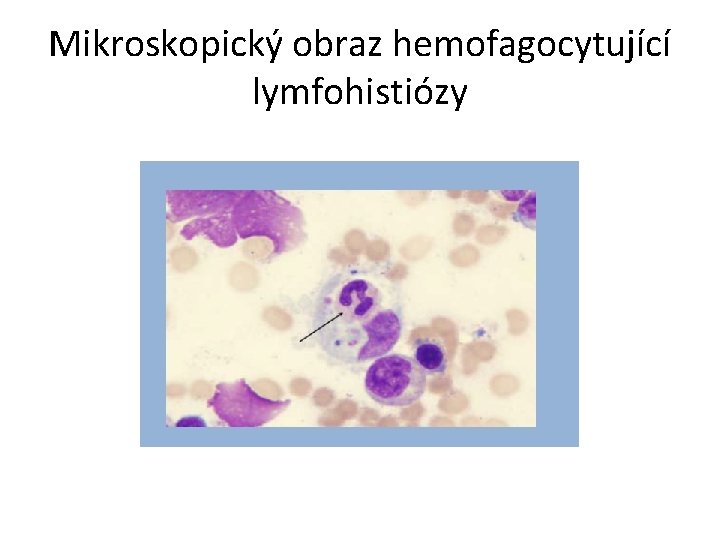 Mikroskopický obraz hemofagocytující lymfohistiózy 