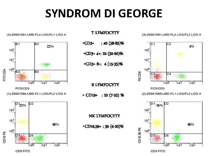 SYNDROM DI GEORGE T LYMFOCYTY 22% • CD 3+ : 40 (58 -85)% 4%