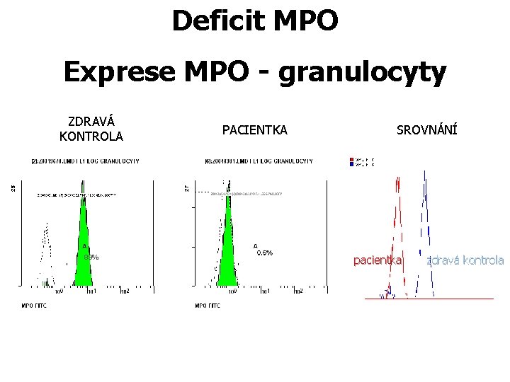 Deficit MPO Exprese MPO - granulocyty ZDRAVÁ KONTROLA 89% PACIENTKA SROVNÁNÍ pacientka zdravá kontrola Deficit MPO Exprese MPO - granulocyty ZDRAVÁ KONTROLA 89% PACIENTKA SROVNÁNÍ pacientka zdravá kontrola