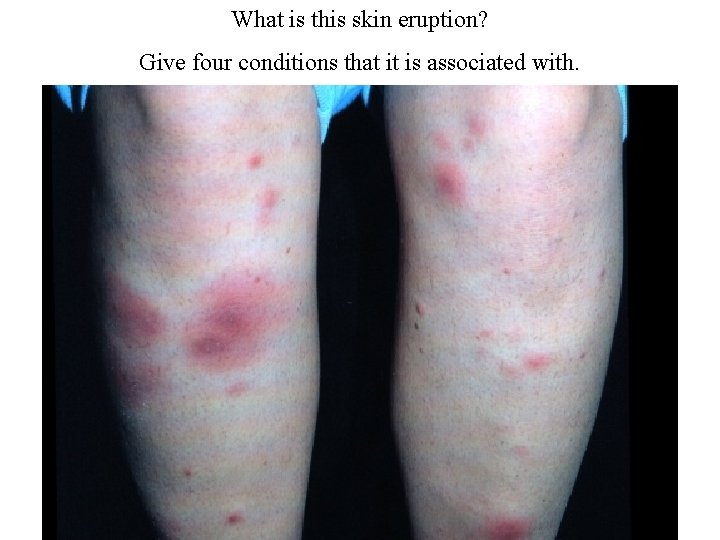 What is this skin eruption? Give four conditions that it is associated with. 