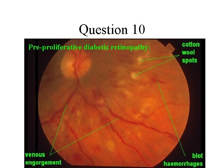 Question 10 Pre-proliferative diabetic retinopathy: 