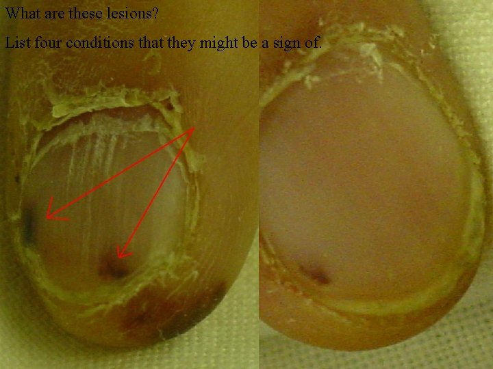 What are these lesions? List four conditions that they might be a sign of.