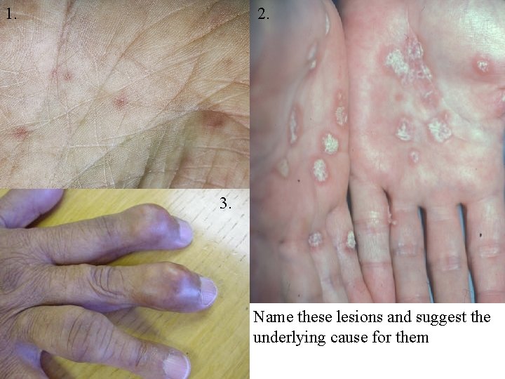 1. 2. 3. Name these lesions and suggest the underlying cause for them 