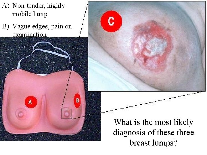 A) Non-tender, highly mobile lump B) Vague edges, pain on examination What is the