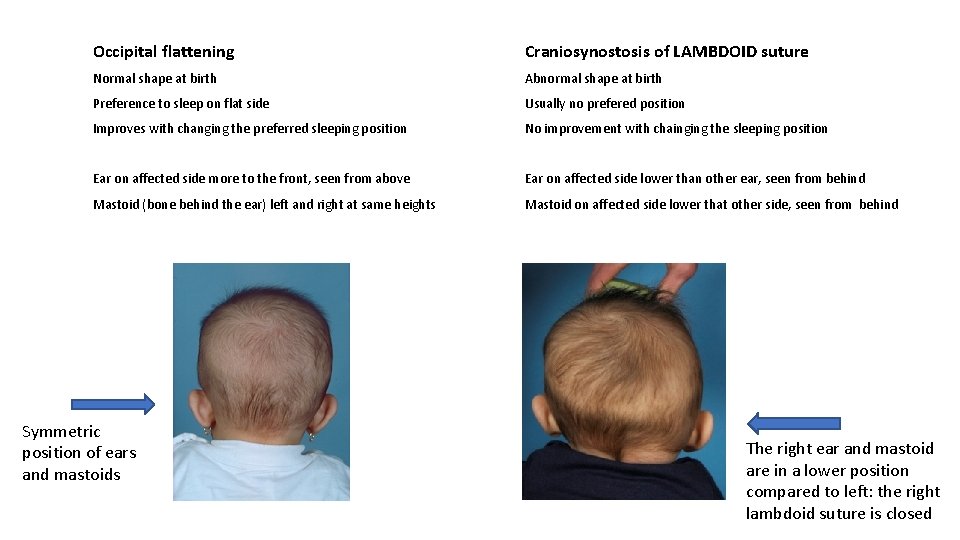 Occipital flattening Craniosynostosis of LAMBDOID suture Normal shape at birth Abnormal shape at birth Occipital flattening Craniosynostosis of LAMBDOID suture Normal shape at birth Abnormal shape at birth