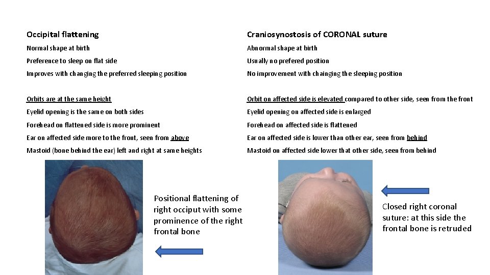 Occipital flattening Craniosynostosis of CORONAL suture Normal shape at birth Abnormal shape at birth Occipital flattening Craniosynostosis of CORONAL suture Normal shape at birth Abnormal shape at birth