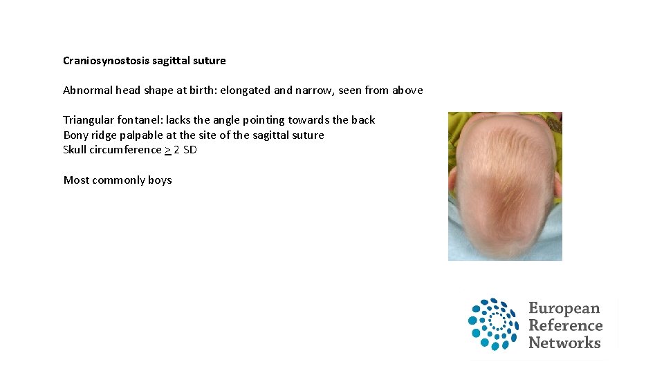 Craniosynostosis sagittal suture Abnormal head shape at birth: elongated and narrow, seen from above Craniosynostosis sagittal suture Abnormal head shape at birth: elongated and narrow, seen from above