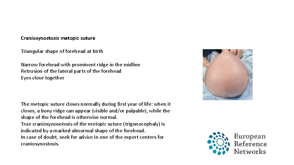 Craniosynostosis metopic suture Triangular shape of forehead at birth Narrow forehead with prominent ridge Craniosynostosis metopic suture Triangular shape of forehead at birth Narrow forehead with prominent ridge