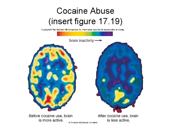Cocaine Abuse (insert figure 17. 19) Cocaine Abuse (insert figure 17. 19)
