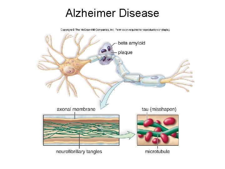 Alzheimer Disease Alzheimer Disease