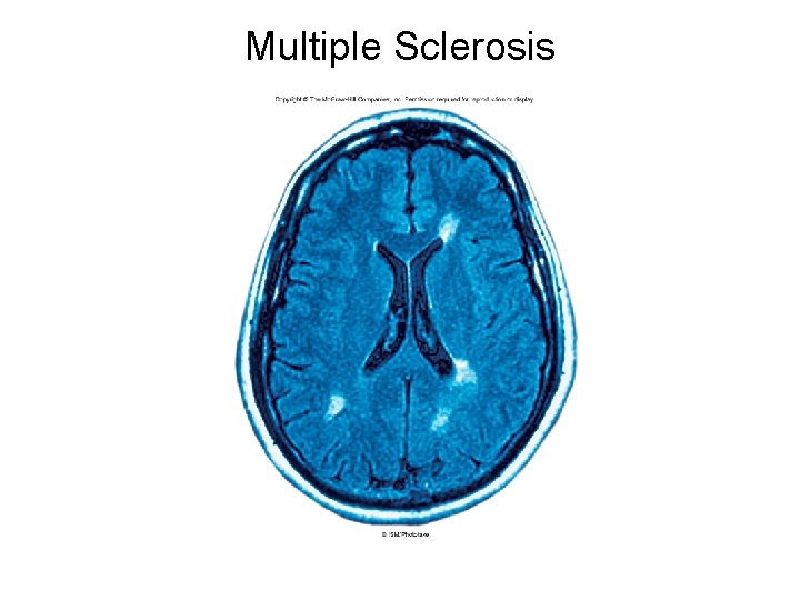 Multiple Sclerosis Multiple Sclerosis