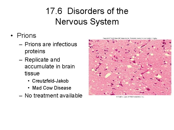 17. 6 Disorders of the Nervous System • Prions – Prions are infectious proteins 17. 6 Disorders of the Nervous System • Prions – Prions are infectious proteins