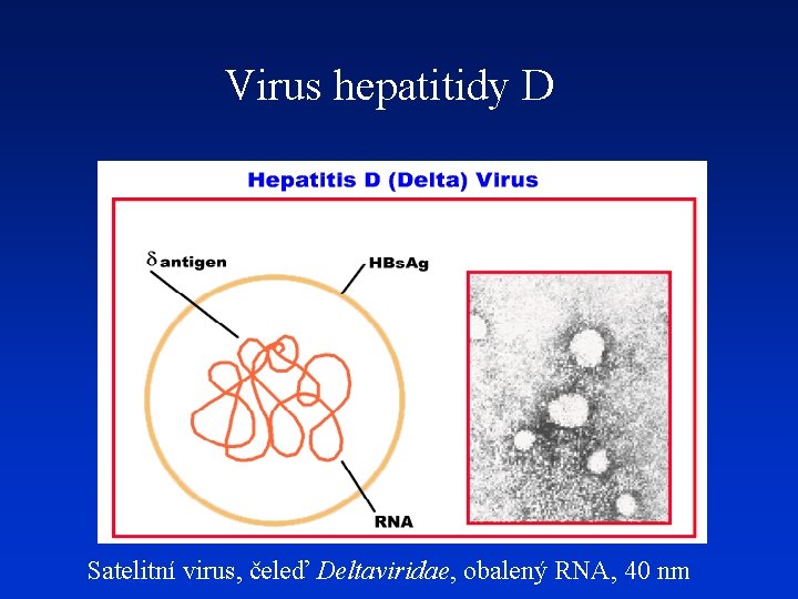 Virus hepatitidy D Satelitní virus, čeleď Deltaviridae, obalený RNA, 40 nm 