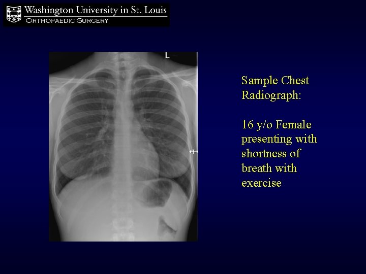 Sample Chest Radiograph: 16 y/o Female presenting with shortness of breath with exercise 