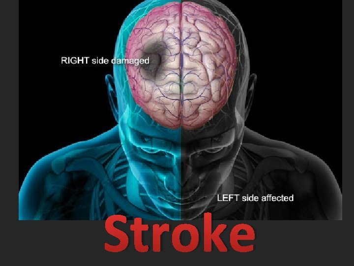 Stroke 