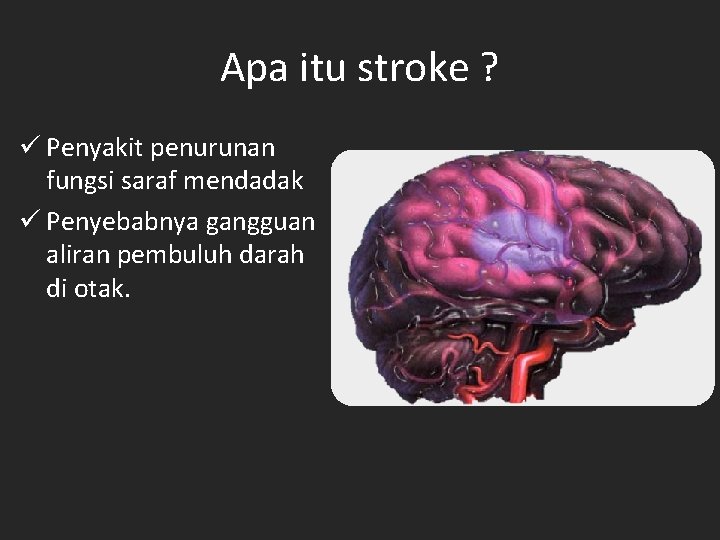 Apa itu stroke ? ü Penyakit penurunan fungsi saraf mendadak ü Penyebabnya gangguan aliran