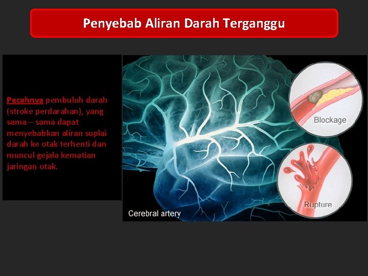 Penyebab Aliran Darah Terganggu Terbentuknya sumbatan pada pembuluh darah ( stroke iskemik ). Pecahnya