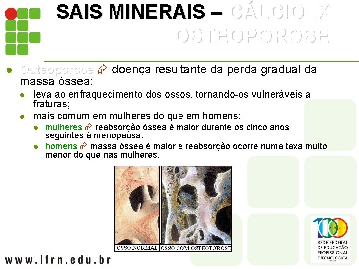 SAIS MINERAIS – CÁLCIO X OSTEOPOROSE l Osteoporose doença resultante da perda gradual da