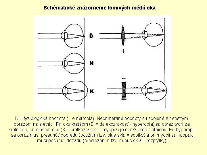 Schématické znázornenie lomivých médií oka N = fyziologická hodnota (= emetropia). Neprimerané hodnoty sú