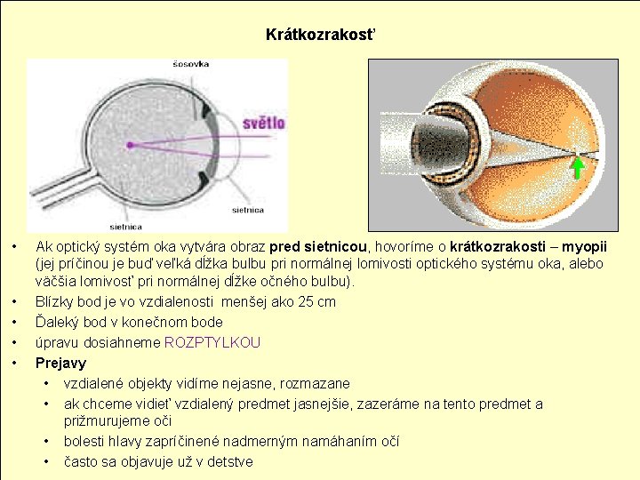 Krátkozrakosť • • • Ak optický systém oka vytvára obraz pred sietnicou, hovoríme o