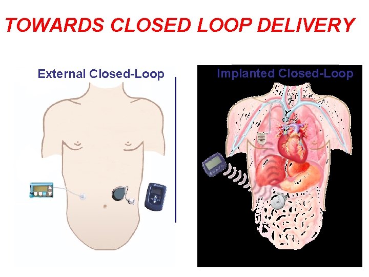TOWARDS CLOSED LOOP DELIVERY External Closed-Loop Implanted Closed-Loop 