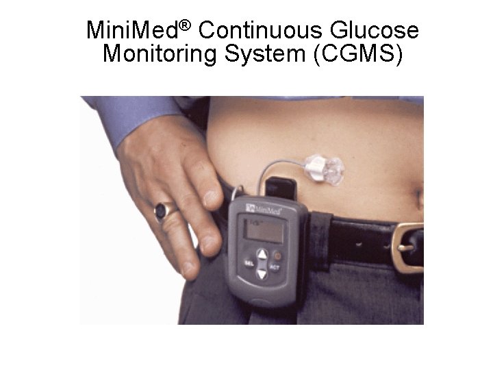 Mini. Med® Continuous Glucose Monitoring System (CGMS) 