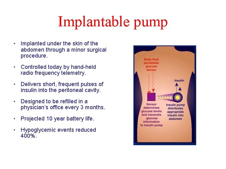 Implantable pump • Implanted under the skin of the abdomen through a minor surgical