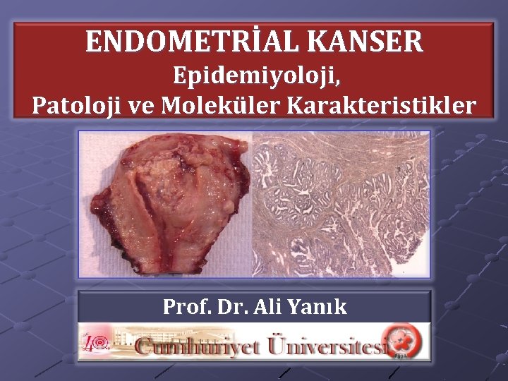 ENDOMETRİAL KANSER Epidemiyoloji, Patoloji ve Moleküler Karakteristikler Prof. Dr. Ali Yanık s - TÜRKİYE