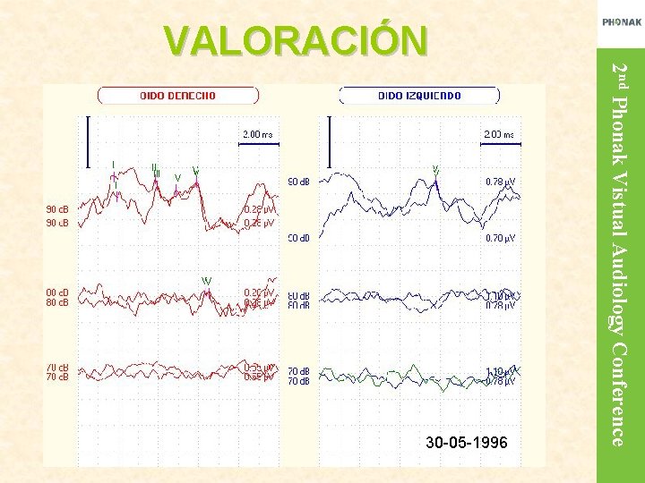 30 -05 -1996 2 nd Phonak Vistual Audiology Conference VALORACIÓN 