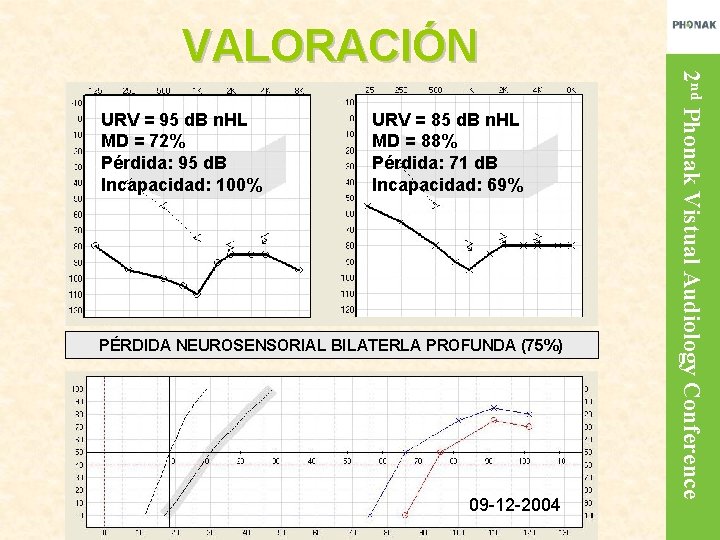 URV = 95 d. B n. HL MD = 72% Pérdida: 95 d. B