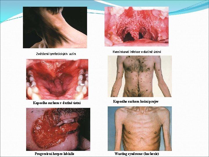Zvětšení lymfatických uzlin Kaposiho sarkom v dutině ústní Progresivní herpes labialis Kvasinková infekce v