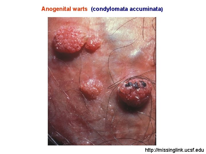 Anogenital warts (condylomata accuminata) http: //missinglink. ucsf. edu 